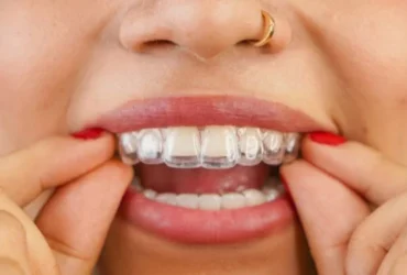 Ortodonzia Invisibile